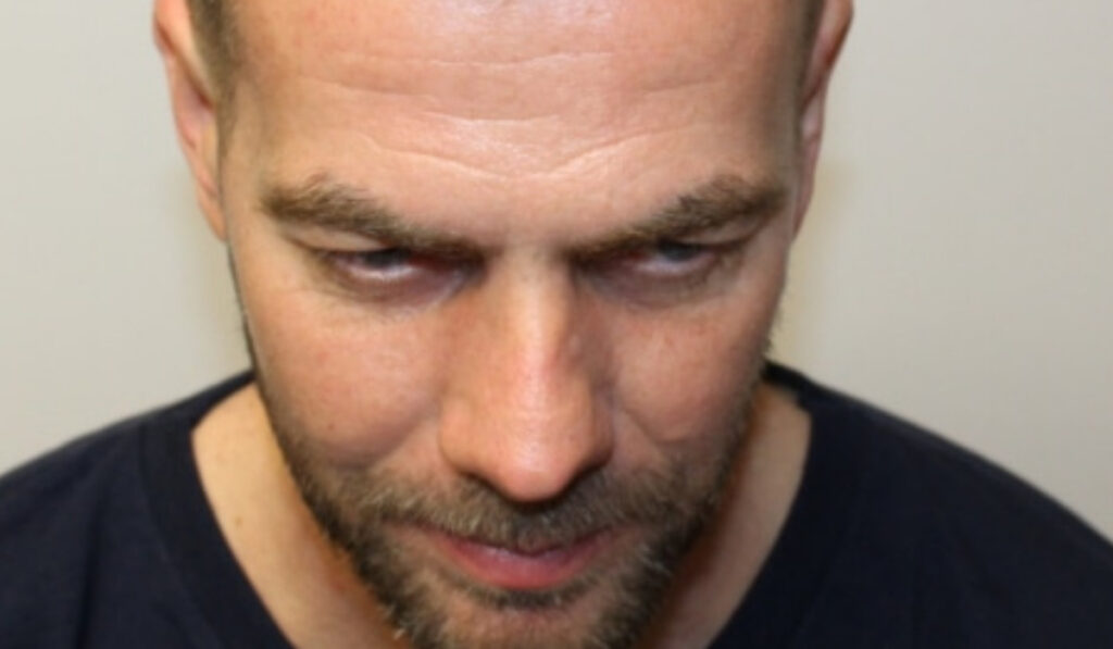 best hair transplant uk