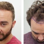 best hair transplant uk