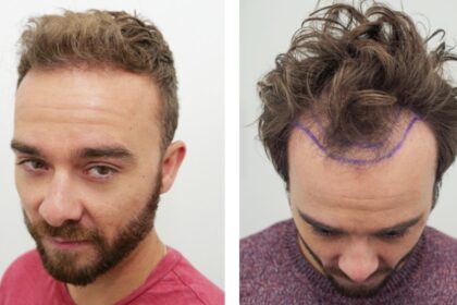 best hair transplant uk