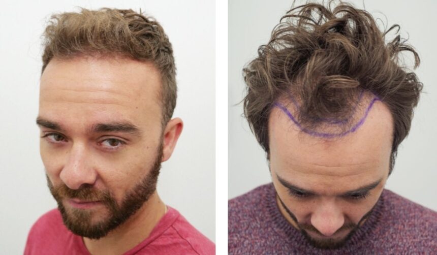 best hair transplant uk